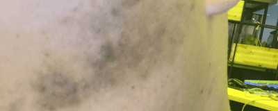 ​如何快速消除黑色痘印