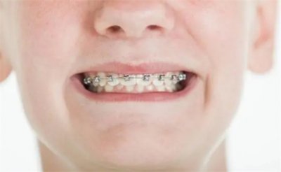 ​为什么建议不要随便整牙