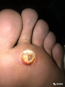 ​鸡眼的横切面（足底的肉刺你了解吗）