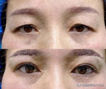 ​提眉术前后对比照片，想做的姐妹来看看提眉术前后的变化