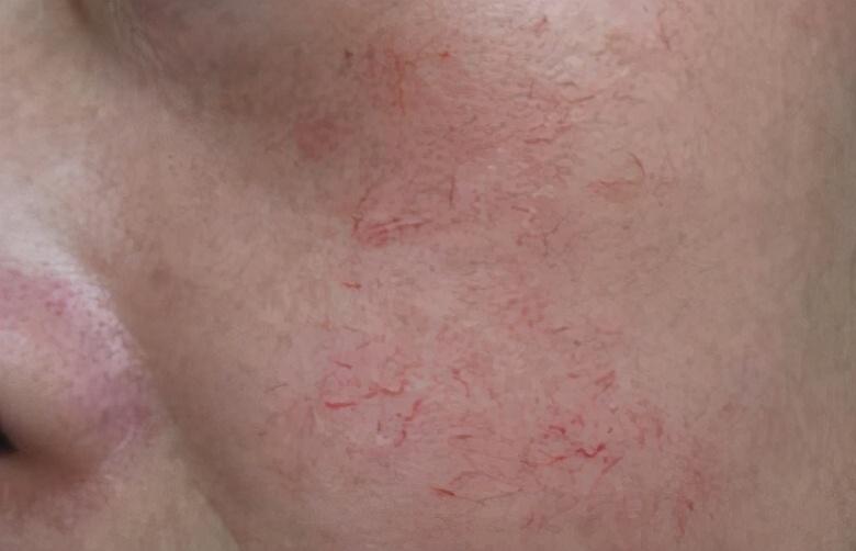 治疗红血丝需要的费用是多少_影响价格的因素