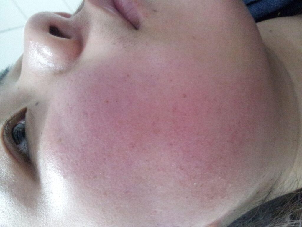 治疗红血丝需要的费用是多少_影响价格的因素