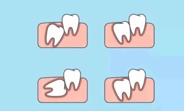 生活长出智齿的原因是什么?智齿会造成哪些问题? 2