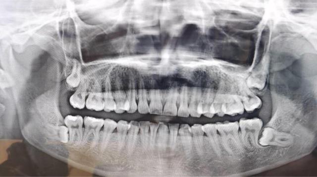 生活长出智齿的原因是什么?智齿会造成哪些问题? 1