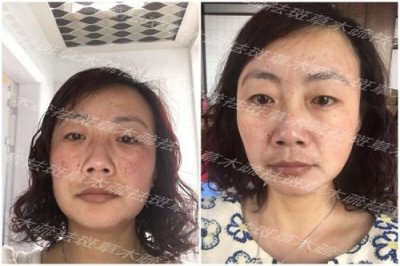 ​哪种祛斑效果好又不伤害皮肤(哪种祛斑效果好不反弹)