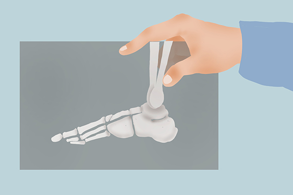 小脚趾甲两瓣的原因(小脚趾指甲分成两瓣对健康的影响)