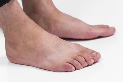 ​小脚趾甲两瓣的原因（小脚趾指甲分成两瓣对健康的影响）