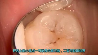 ​牙齿色素沉着图片(牙齿沉淀的色素图片)