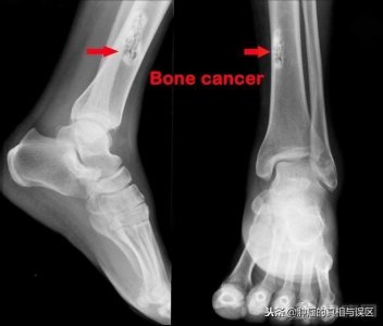 ​骨癌的早期症状一般能持续多久 骨癌早期身体会有什么表现